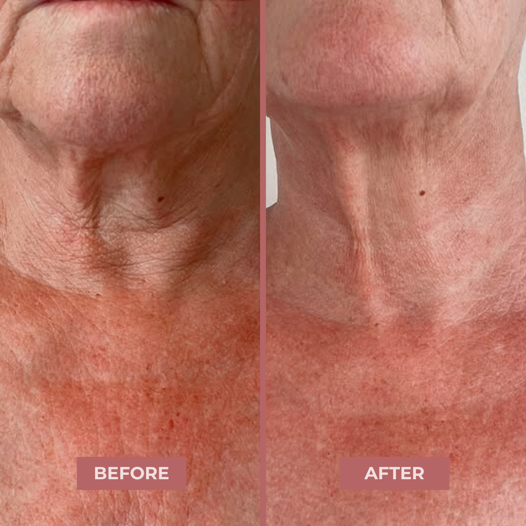 BioCollagen Neck Patches