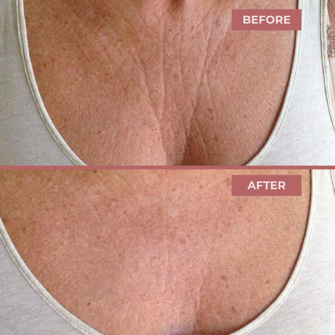 Bio-Collagen Chest Patches